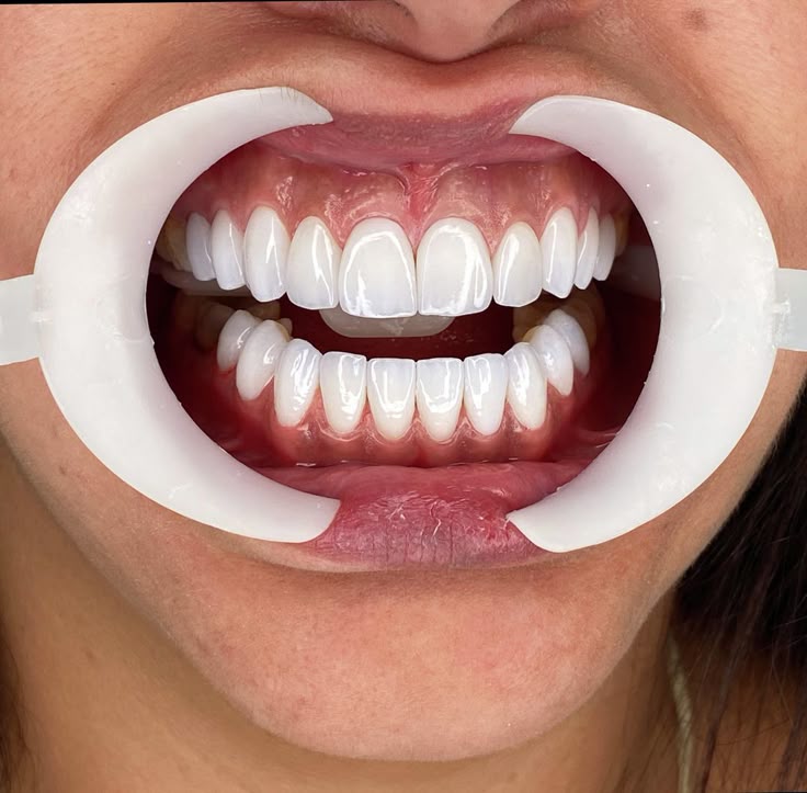 Dental Veneers – Sanidhya Dental Solution Rohini